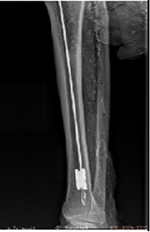 Intraoperative X-ray showing that the broken nail extractor was inserted into the medullary cavity and passed through the canal of the broken nail.