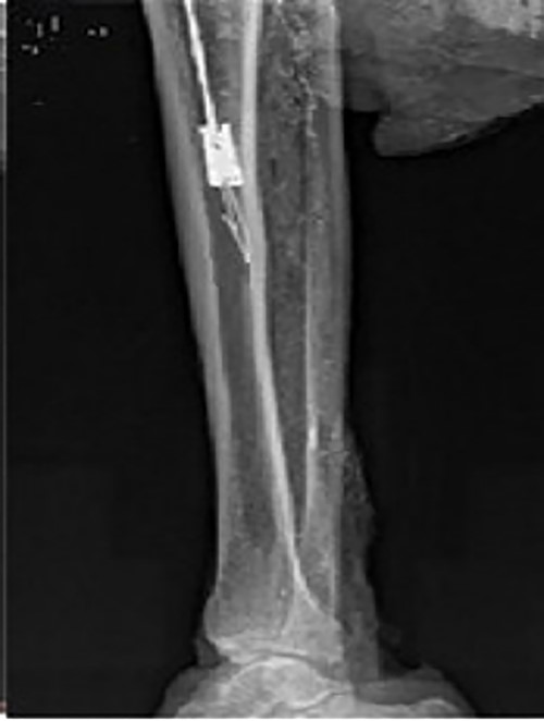 Intraoperative X-ray showing that the broken nail extractor was pulled back and the barb hooked the canal wall.