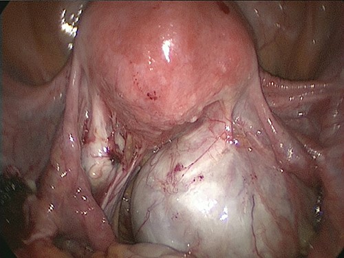 A large right ovarian cyst adherent to the uterus and retroperitoneum was identified within the Douglas cavity.