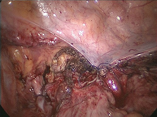 The peritoneum was massively disrupted such that the upper and lower peritoneum could not be sutured.