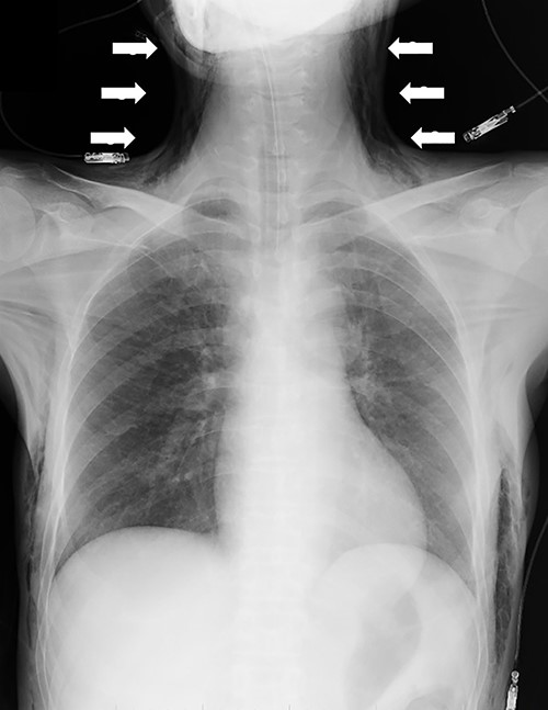 Chest radiography demonstrating the progression of the subcutaneous emphysema to the mandible (arrows).