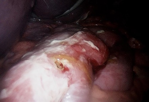 Alimentary limb perforation at laparoscopy.