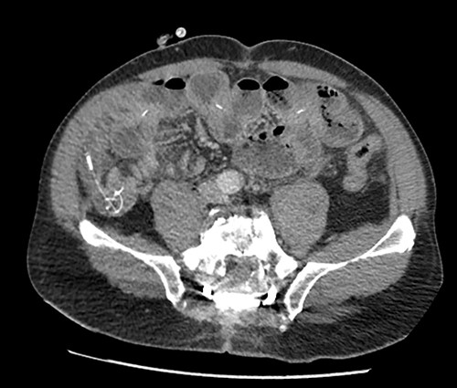 Preoperative CT scan showing intestinal occlusion and a knot formation.