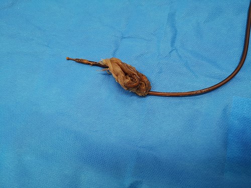 Extracted bezoar.