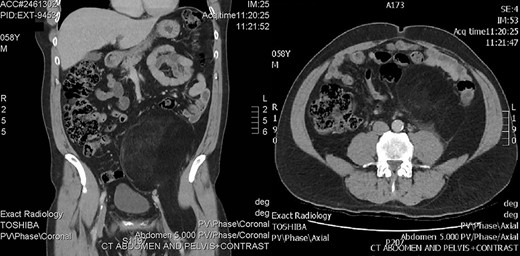 CT showing retroperitoneal mass.