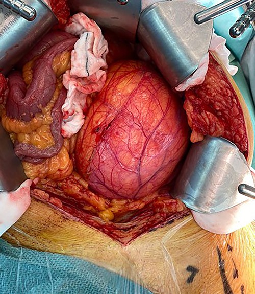 Intraoperative photo showing size of lesion and displacement of bowel.