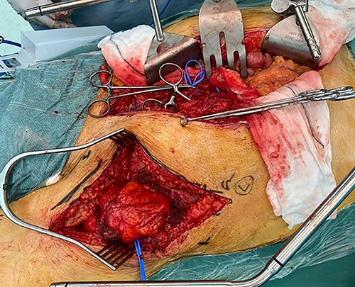 Intraoperative photo showing groin incision with inguinal ligament divided, to allow adequate dissection in lower pelvis and groin.