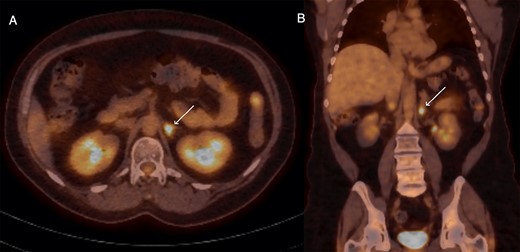 Axial (A) and coronal (B) sections of FDG-PET demonstrating glucose-avid lesion in the left adrenal (arrow).
