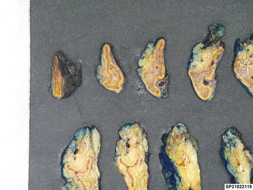 Cut sections of the left adrenal specimen.