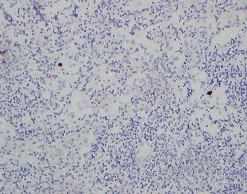 Immunohistochemical stain for CMV, with infected cells (brown) showing characteristic CMV nuclear inclusions.