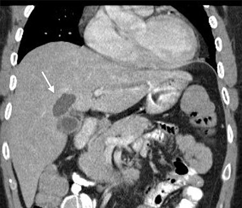 Computed tomography image showing an intrahepatic cyst (arrow).