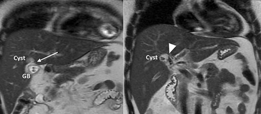 MRCP showing a cyst connected to the cystic duct (arrow) and the right anterior sectoral bile duct (arrowhead).
