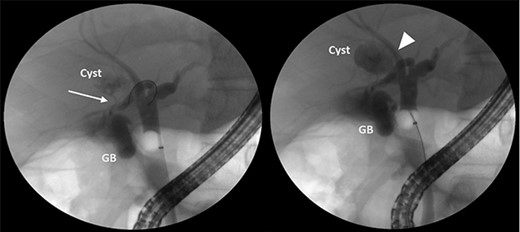 ERCP showing that the cyst can be filled with contrast from the cystic duct (arrow) and the right anterior sectoral bile duct (arrowhead).