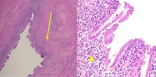 Pathological examination revealed a cyst with a fibrous wall (arrow), dense chronic inflammatory infiltration, lined by columnar epithelium (arrowhead). Mild reactive atypia, associated with marked chronic inflammatory cell infiltration, was noted. No signs of epithelial dysplasia were observed.