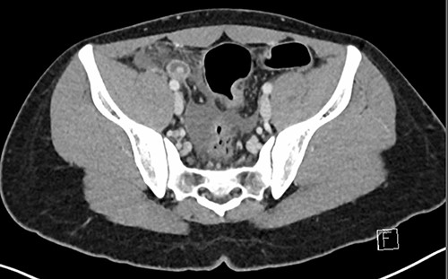Axial CT image demonstrating the inflamed appendix containing hyperdensities.