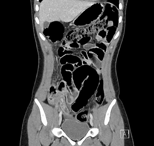 Coronal CT image demonstrating the inflamed appendix containing hyperdensities.