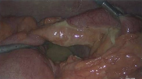 Intra-operative photograph of the inflamed appendix.