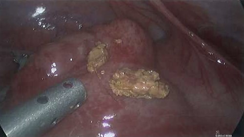 Intra-operative photograph of faecoliths containing hair.