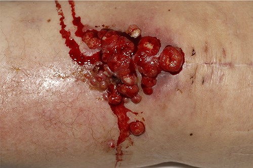 Multiple granulating areas with discharge along the scar of a previous total knee replacement.