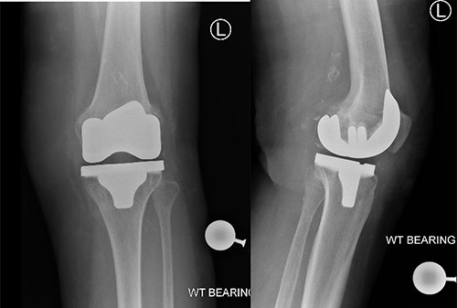 Post-operative radiographs showing satisfactory position of prosthesis for left total Knee replacement.