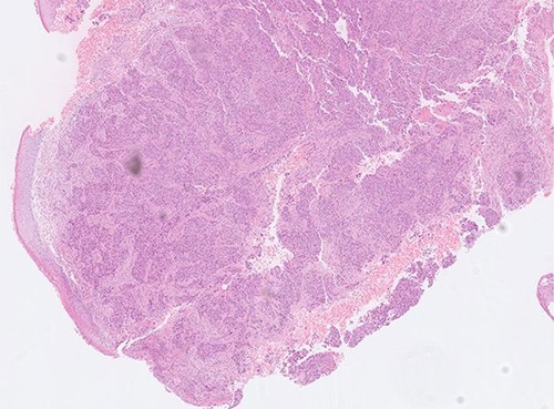 Histopathology slide showing poorly differentiated adenocarcinoma with sheets and nests of malignant cells.