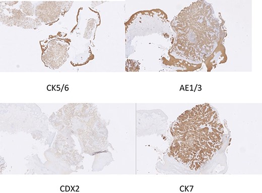 Immunohistochemistry slide showing poorly differentiated adenocarcinoma compatible with breast carcinoma.