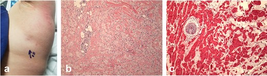 Tethered area of skin in the left axillary fold (a). Histology of the axillary fold GCT (H&E ×200)(b), with S100 immunohistochemical staining (c).