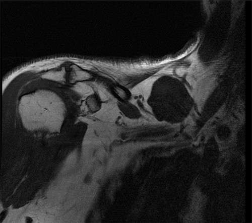 T1-weighted MRI sequence showing a supraclavicular cyst.