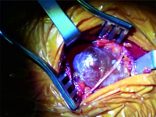 Cyst removal.