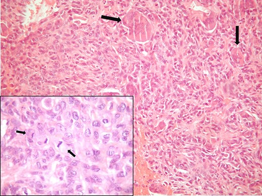 Pathologic examination shows osteoclast-like giant cell carcinoma (H&E, ×100). Insert (H&E, ×400).