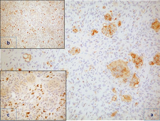 Immunohistochemical staining shows that the osteoclast-like giant cells were positive for CD68 (a, CD68 ×200). Mononuclear cells were positive for p63 (b, p63 ×100) and GATTA3 (c, GATTA3 ×20).