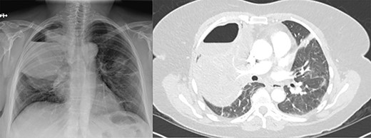 (A) Plain film of chest showing apical hydropneumothorax. (B) Computed tomography axial image demonstrating a complex hydropneumothorax with significant right sided parenchymal infiltrate.