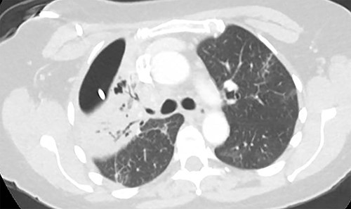 Axial image demonstrating right upper lobe consolidation and residual pneumothorax despite tube thoracostomy.