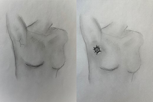 (A) Location of incision for Clagett open thoracostomy, and (B) maturation of thoracostomy with skin flaps.