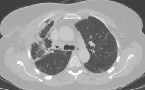 Axial CT image 4 weeks after Clagett closure.