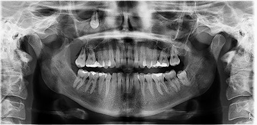 Orthopantomogram depicting the ectopic tooth in the right maxillary sinus.