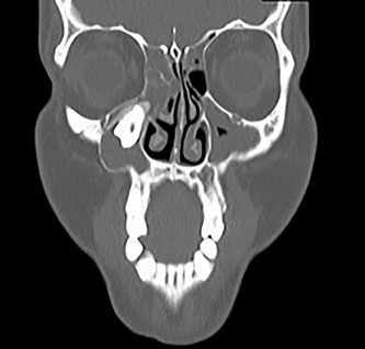 Coronal CT image of the right ectopic tooth at the antrum of the right maxillary sinus.