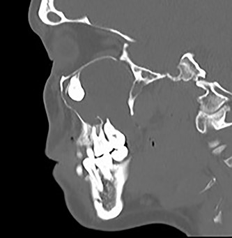 Sagittal CT image of the right ectopic tooth at the antrum of the right maxillary sinus.