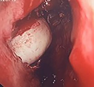 Intra-operative image of the ectopic tooth at the right osteomeatal complex.