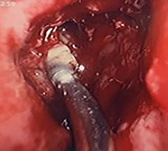 Intra-operative image of the ectopic tooth at the right osteomeatal complex, with curved suction facilitating enucleation.