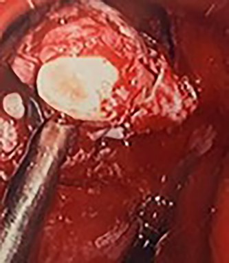 Intra-operative image of the ectopic tooth at the right osteomeatal complex, with curved suction facilitating enucleation.