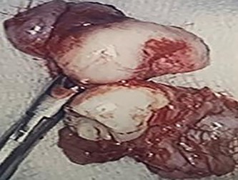 Two extracorporeal teeth that were removed from the right maxillary sinus.