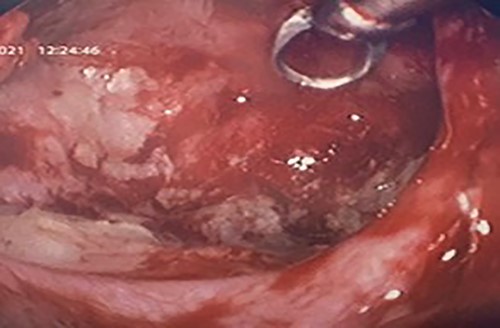 Intra-operative image with a 70° scope depicting the cleared maxillary sinus cavity, the scope facilitated cautery at the base of the cyst.