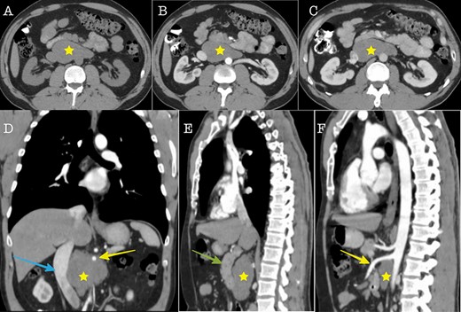 Cross sectional imaging (A): Axial CT without contrast medium, (B) Axial CT contrast-enhanced, arterial phase, (C) Axial CT, contrast-enhanced, portal venous phase. The images show a large solid retroperitoneal mass (yellow star) isoattenuating to the muscles, without contrast enhancement. (D) Coronal reconstruction and (E, F): Sagittal reconstructions demonstrate the anatomic relationships of the mass with IVC (blue arrow), superior mesenteric artery (yellow arrow) and pancreas (green arrow). The mass is located dorsally to the pancreas, encases the superior mesenteric artery and displaces the IVC to the right.