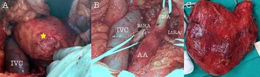 Intraoperative view of the tumor (A), after tumor resection (B) and tumor specimen (C), (AA: abdominal aorta, RtRA: right renal artery, LtRA: left renal artery, IVC: inferior vena cava).