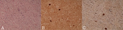 Histology section of (A): Ganglioneuroma composed of variably sized mature ganglion cells with satellite cells deposited in a neuromatous stroma (H-Ex100), (B): NSE staining of the ganglion cells (NSEx100) and (C): S100p staining of the gaglion cells and the schwannian stroma (S100px100).