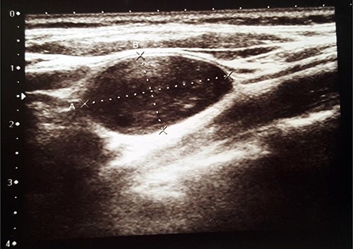 US showed ovoid-shaped mass.