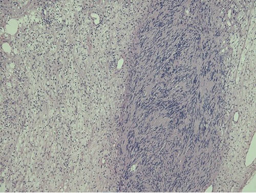 Biphasic tumour: compact hypercellular Antoni A area (right) and myxoid hypocellular Antoni B area (left).