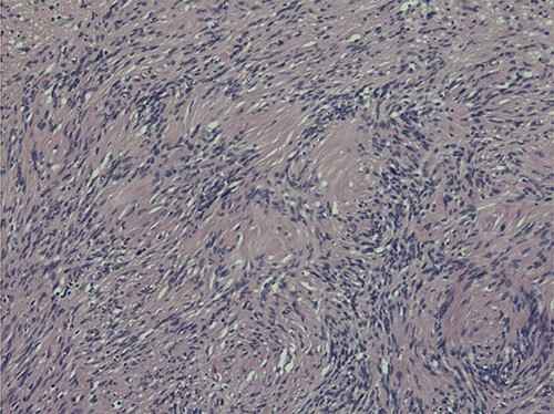 Nuclear palisading around fibrillary process (Verocay bodies) is seen in cellular area; cells are narrow, elongated and wavy with tapered ends interspersed with collagen fibres.