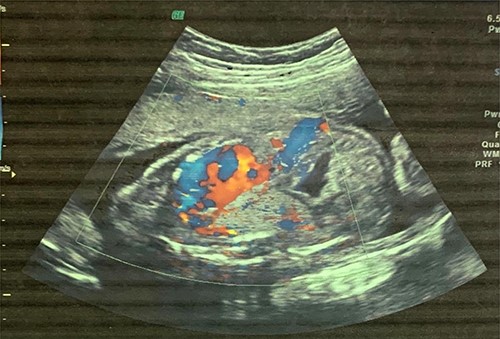 Fetal US at 20 weeks’ gestation showing an echogenic mass in the left lower lobe, which was initially thought to be congenital pulmonary adenomatoid malformation.